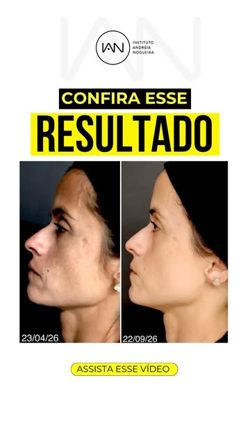 Oi pessoal, confira esse antes e depois que mostra como o cuidado contínuo faz diferença na qualidad