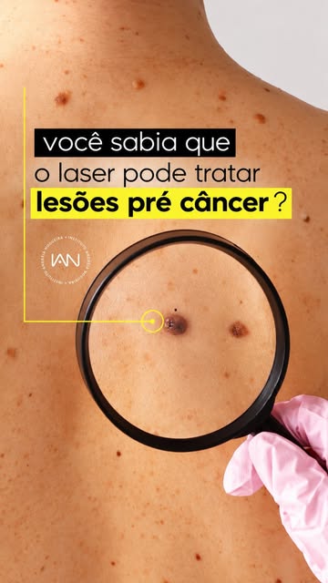 Para pacientes com muita exposição solar, manchas, queratoses actínicas e outras lesões, existem tra
