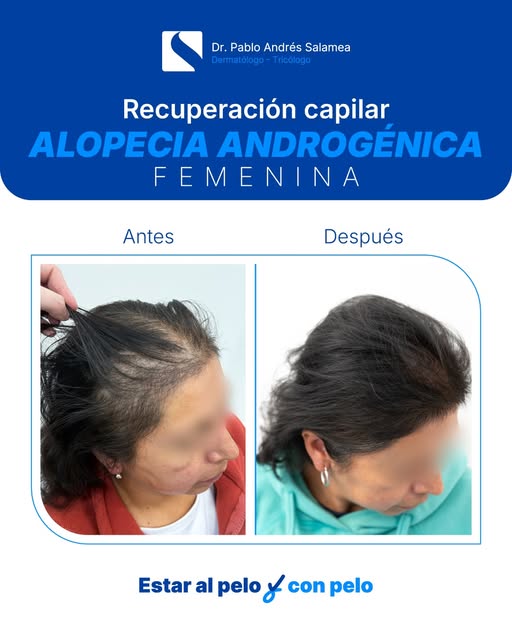 ✨ 4 meses, un cambio que se nota.

Esta paciente continúa con su tratamiento de recuperación capilar
