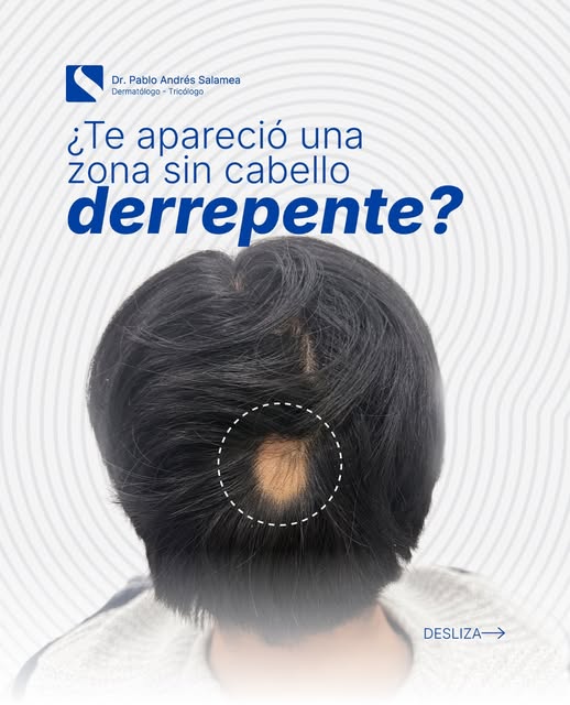 ¿Te apareció una zona sincabello de la nada? 👀

No lo ignores.‼️
Podría ser una señal de alopecia a