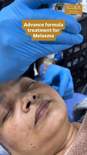 Stubborn melasma needs deeper clinical action than surface creams can provide! ✨🤍

Melasma and deep