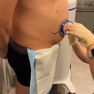 Bye bye, dad bod 👋🏻

Ditch the dad bod with Coolsculpting Elite treatment in just 35 mins! Achieve