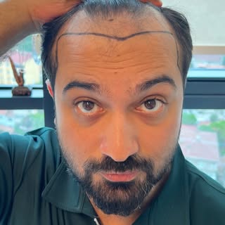 My #hairtransplantdiary 😉👍 #hairtransplantturkey #hairtransplantistanbul #hairtransformation #hair