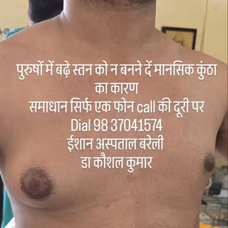 क्या आप Gynecomastia (पुरुषों में बढ़े स्तन ) से कुंठा ग्रस्त हैं या दूसरी जगह इसका आप्रेशन कराने के