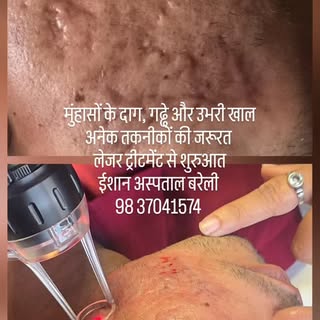 मुंहासों से खराब गालों की त्वचा
अनेक़ों तकनीकों की जरूरत 
संपूर्ण इलाज एक छत के नीचे, 
ईशान अस्पताल,