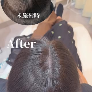 分け目やつむじの透け感が気になっていませんか？🌿

頭皮アートメイクは、毛が生えているような自然な印象を再現する施術です。

分け目やつむじの透け感を目立ちにくくすることで、ヘアスタイルが整って見え