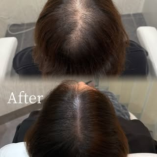 頭皮アートメイクをすることで、気になる頭皮の透け感を自然にカバーします🌿

「分け目が気になる」
「つむじの透け感が気になる」
「毎日のセットに時間がかかる」

そんなお悩みを、自然な仕上がりでサポ