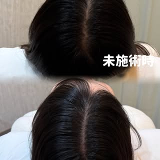 頭皮アートメイク 1回目の変化✨

「1回で完成しますか？」
というご質問をよくいただきます。

答えは、1回では完成しません。

頭皮アートメイクは、一度に濃く入れる施術ではなく、色素を少しずつ重ね