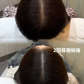 【2回目施術 Before → After🌿】

1回目でベースを整えた上で、2回目は色の入り具合やドットのバランスを確認しながら、さらに密度感を調整していきます。

施術を重ねることで、少しずつ自