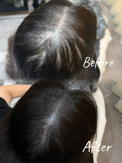 20代女性の頭皮アートメイク症例です🌿

分け目〜つむじ周辺の透け感が強く、頭皮が目立って見えることをお悩みでした。

頭皮アートメイクでは、頭皮に専用の色素を細かく点状に入れることで、髪の毛がある