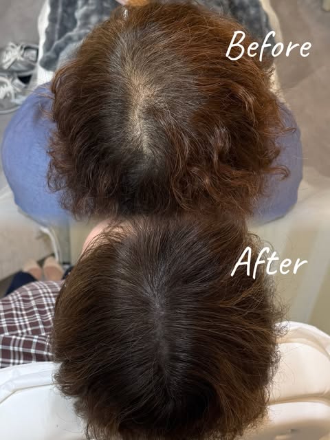 【3回目施術後 Before → After】

頭皮アートメイク、3回目施術後のBefore・Afterです🌿

1回目・2回目と少しずつ濃さや密度を調整し、3回目で全体のバランスを見ながら最終調