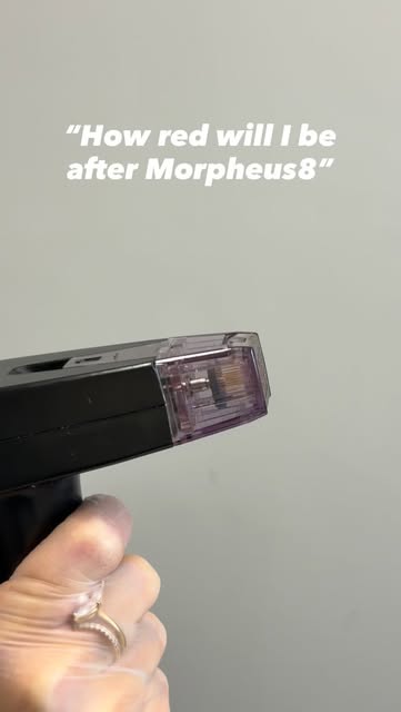 So, what can you actually expect after Morpheus8? 👀

Straight afterwards, your skin will usually lo