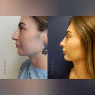 Natural noses don't look "done." They just look like you -- only Better! 

#dmv #rhinoplasty #viralr