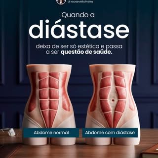 ✨ A diástase abdominal é frequentemente percebida pela alteração no contorno do abdome, mas ela pode