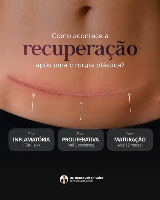 A recuperação após uma cirurgia plástica acontece por etapas e cada fase tem seu papel na cicatrizaç