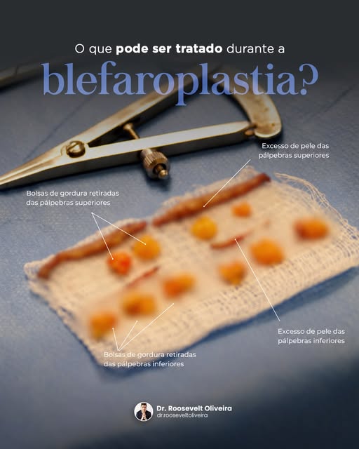A blefaroplastia pode ajudar a tratar o excesso de pele e as bolsas de gordura nas pálpebras, contri