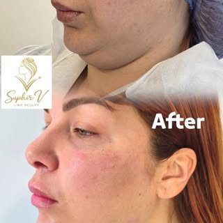 Saphir V-Line Sculpt™ : la solution médicale pour éliminer le double menton sans chirurgie

Votre do