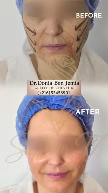 ✨ Saphir Lift™ – Le protocole médical global de raffermissement du visage tiers moyen et inférieur 
