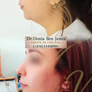 Traitement double menton sans chirurgie 
Saphir Vline Sculpt avant après 
Cabinet Dr Donia Ben Jemia