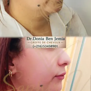 Traitement double menton et ovale du visage 
Saphir Vline Sculpt avant après