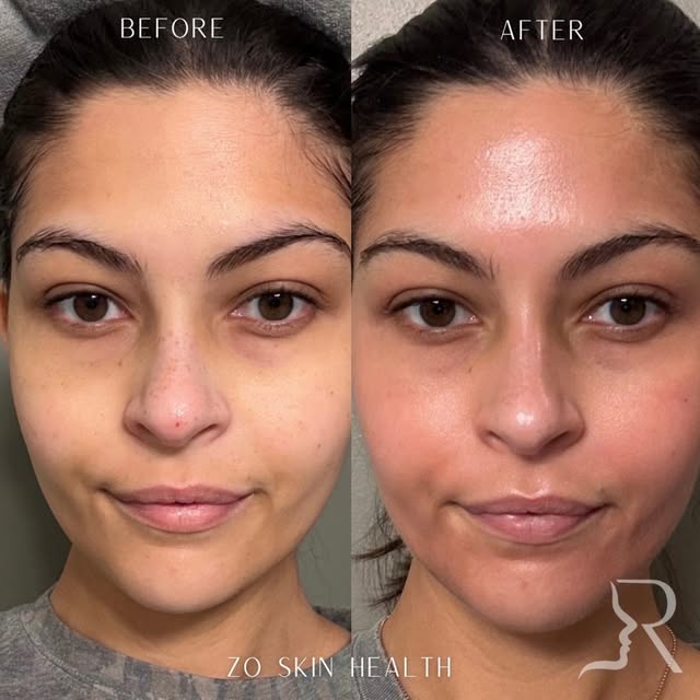The strongest aesthetic results often make people notice that you look refreshed—not wonder what you