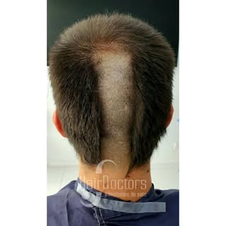 Ventajas de realizar el trasplante capilar con el pelo corto.

✅La extracción es fácil y homogénea.
