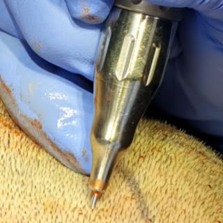 Extracción FUE ( Follicular Unit Extraction). Se extrae cada unidad folicular individualmente.  Es u