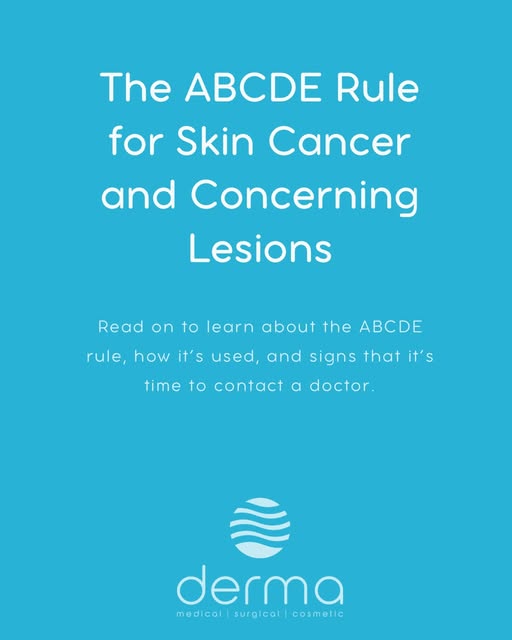 ☀️ Know your ABCDE of skin cancer ☀️ 

Your skin can change, knowing what to look for could help you