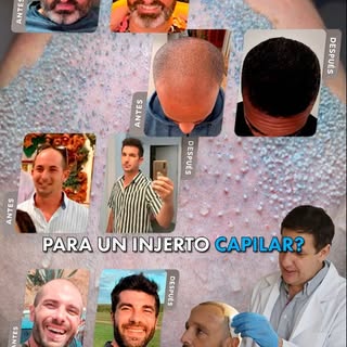 ¿Cuál es el mejor candidato para un injerto capilar?

Antes que nada se tiene que determinar:
¿Qué t
