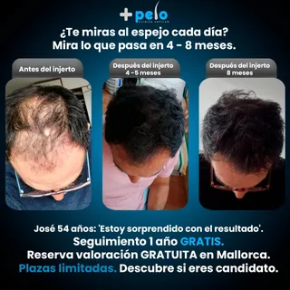 ¿Te miras al espejo y ves cómo tu pelo se va en 4-8 meses? 😔 

Mira a José (54 años): "Estoy sorpre