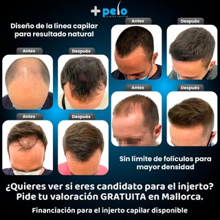 🔍 Compara el ANTES y el DESPUÉS.
Ese cambio es posible gracias a un diseño de línea capilar persona