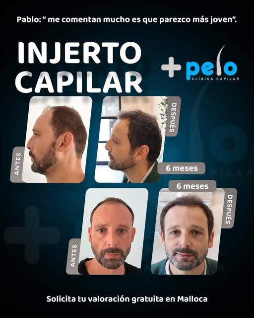 ¿El secreto para parecer más joven? La naturalidad de un injerto capilar bien hecho. ✨ Pablo es la p