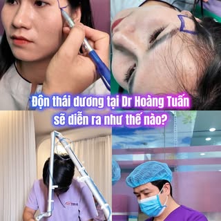 TỪ A→Z QUY TRÌNH ĐỘN THÁI DƯƠNG TẠI DR HOÀNG TUẤN
Từ thăm khám, đo vẽ đến thực hiện đều được bác sĩ 