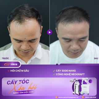 🔥 NHỮNG KẾT QUẢ THỰC TẾ SAU CẤY TÓC TẠI DR HOÀNG TUẤN
Hói chữ M, trán cao, hói đỉnh đầu, tóc thưa… 