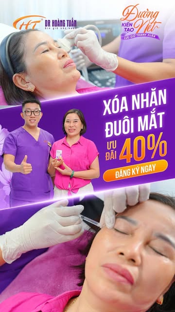 BOTOX XÓA NHĂN ĐUÔI MẮT - CHỈ 5 PHÚT TỰ TIN CƯỜI RẠNG RỠ 

Nhăn đuôi mắt nhiều mỗi khi cười khiến gư