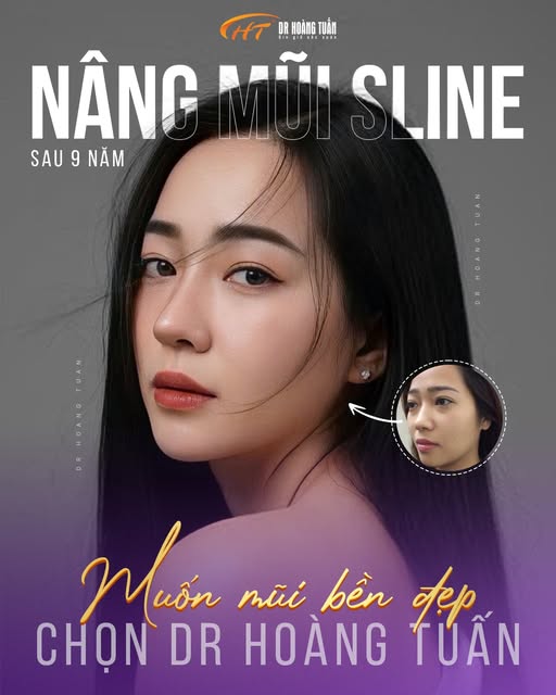NÂNG MŨI 9 NĂM – ĐẸP BỀN THEO THỜI GIAN 😍
Một chiếc mũi đẹp không chỉ nằm ở khoảnh khắc vừa tháo nẹ