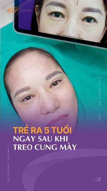 💕 NẾP MÍ TỰ NHIÊN “LỘ DIỆN” SAU TREO CUNG MÀY – giải pháp trẻ hoá đôi mắt được nhiều khách hàng U50