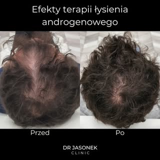 ❓Jak długo trzeba czekać na efekty leczenia? 
To zależy- często 6 lub 12 miesięcy.

W przypadku tego