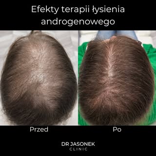 Dzisiejsze efekty pokazują potencjał jaki się kryje w terapii komórkami macierzystymi włosa.

Sytuac