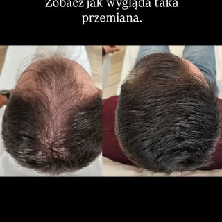 Tak wygląda regeneracja włosów dzięki DR Jasonek ReGrow Protocol etap po etapie.