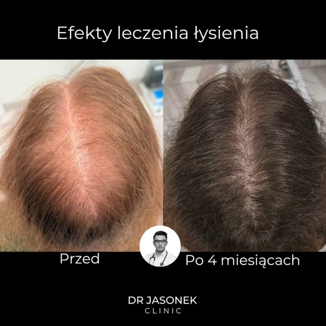 4 miesiące leczenia. Tyle wystarczyło, żeby zobaczyć bardzo wyraźną zmianę.

Pacjentka zgłosiła się 