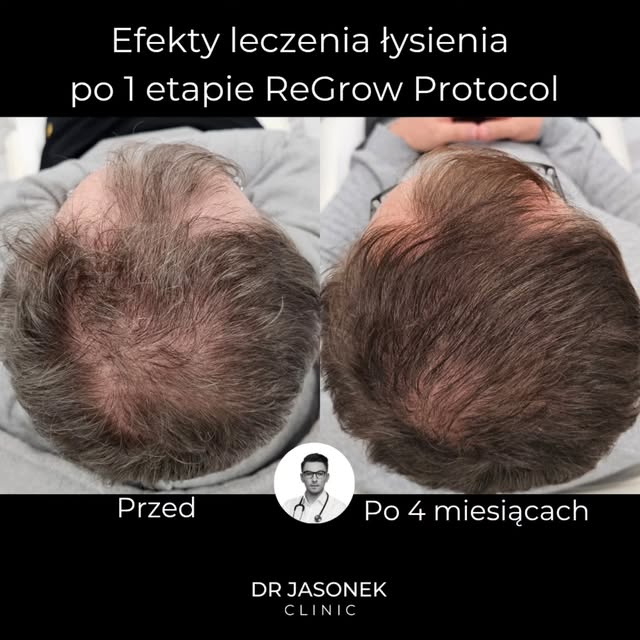 W tym przypadku zmieniła się nie tylko gęstość włosów.

Po leczeniu widzimy poprawę pokrycia skóry g