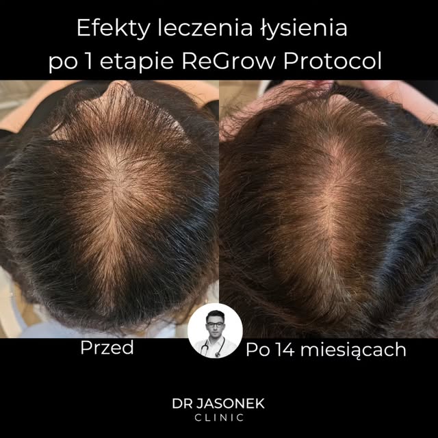 Skuteczne leczenie łysienia nie polega na tym, żeby u każdego zastosować ten sam schemat.

W tym prz