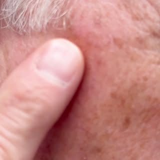 IG-SRT doesn’t have to mean permanent skin damage. See Michael’s results 2.5 years after treatment a