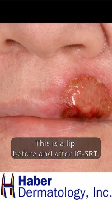 Mohs surgery or IG-SRT? There are different treatment options for skin cancer, and understanding you