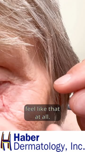 4 years after IG-SRT treatment for basal cell carcinoma under the eye, the skin still looks and feel