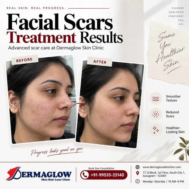 ✨ Facial Scars Treatment Results | Real Skin. Real Progress.

Acne and facial scars can leave behind