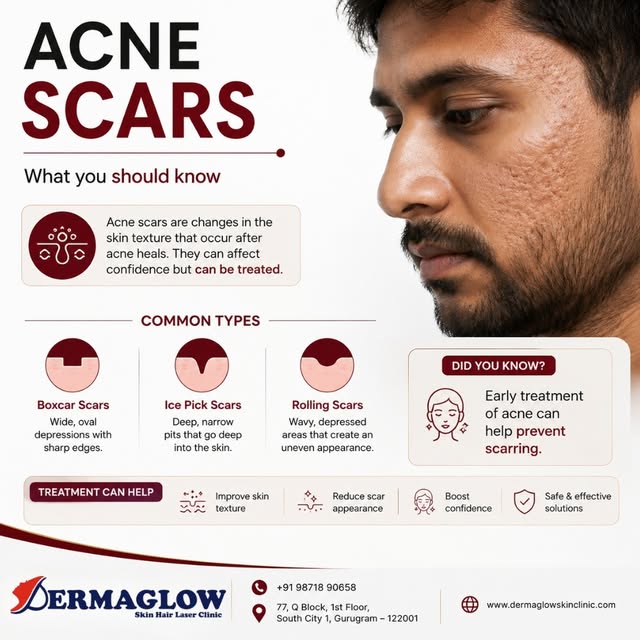✨ Acne Scars: What You Should Know

Acne may heal, but the scars left behind can affect your skin’s 