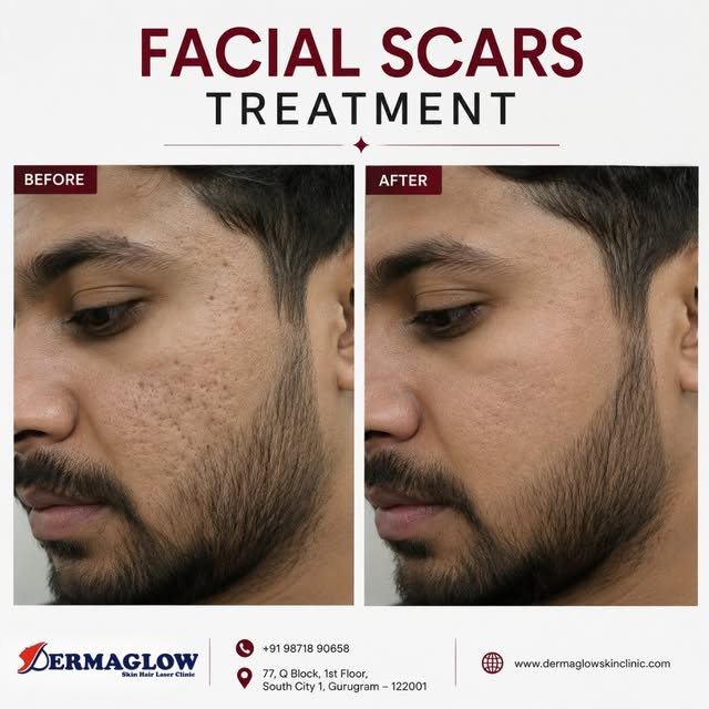 ✨ Facial Scars Treatment | Before & After ✨

Acne and facial scars can affect your skin’s texture an