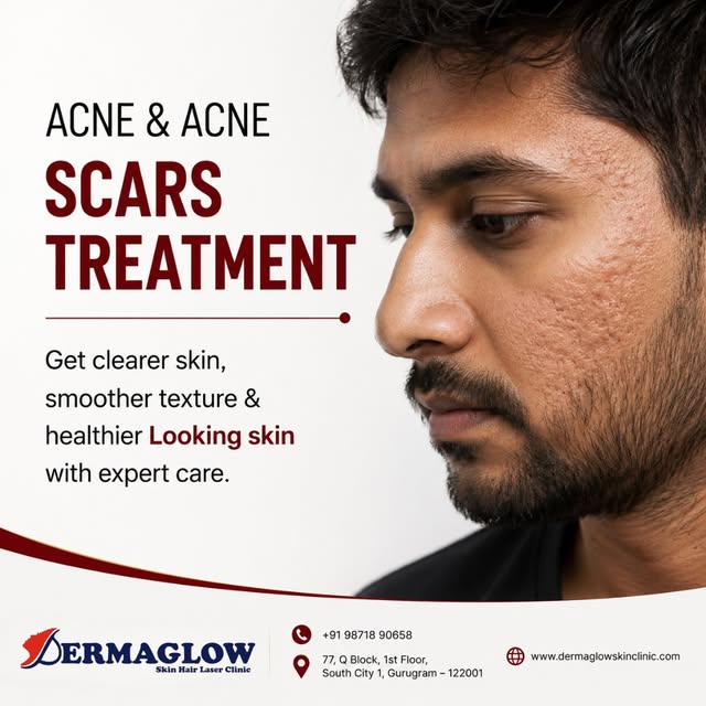 ✨ Acne & Acne Scars Treatment | Get Smoother, Healthier-Looking Skin

Acne may heal, but the marks, 